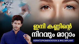 കണ്ണിന്റെ നിറം PERMENANT ആയി മാറ്റാം  treatments to change eye colour [upl. by Caravette723]