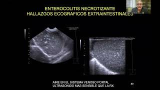 ULTRASONIDO Y DOPPLER EN LA ENTEROCOLITIS NECROTIZANTE DEL RNDR PEDRO UNSHELM [upl. by Dibru]