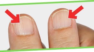 What Ridges In Finger And Toenails Mean For Your Health [upl. by Haneekas]