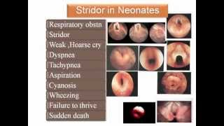 flexible laryngoscopy in congenital stridor [upl. by Mika774]