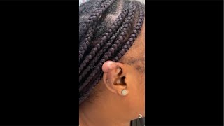 🦻🏾🦻🏾What the hll is that on your ear🙉Helical keloids in Black skin [upl. by Brnaby]