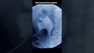 Nefrostomía Percutanea Radiologia Intervencionista [upl. by Eelyac]