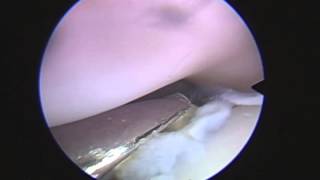 Elbow arthroscopy in a dog with FCP and Incongruency [upl. by Perrins]