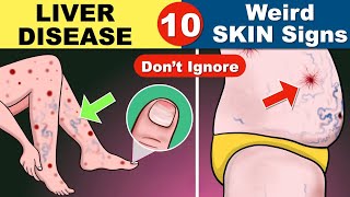 10 Skin signs of Liver Disease  Fatty liver  Cirrhosis of the Liver  Fatty liver Symptoms [upl. by Mick389]