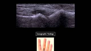 Metacarpophalangeal joint effusion at US [upl. by Atinot226]