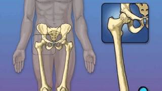 Hip Replacement Surgery PreOp® Patient Education [upl. by Wilie982]