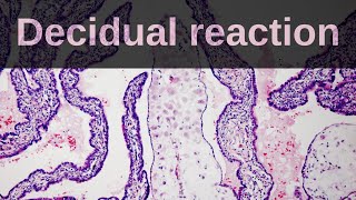 What is Decidual Reaction Pathology mini tutorial [upl. by Finbar]