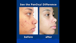 Panicky Acne Foaming Wash Benzoyl Peroxide 10 Maximum Strength Antimicrobial 55 Oz [upl. by Bev755]