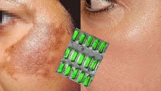 Pigmentation on face cream  Pigmentation on face treatment  How to remove pigmentation from face [upl. by Perkoff]