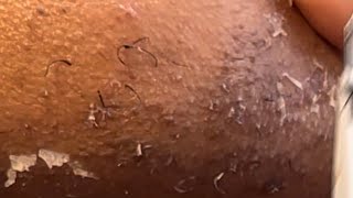 INGROWN HAIR REMOVAL 12  2022  CHEMICAL PEEL [upl. by Eille48]