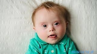 Down syndrome short case trisomy 21 [upl. by Nosmas]