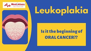 Leukoplakia l Precancerous lesions l Oral pathology l Mediklaas [upl. by Nelubez936]