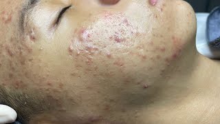 ACNE TREATMENT VU QUYNH MI  Perennial Blackheads On Boy Face 2024FULL [upl. by Cayla420]