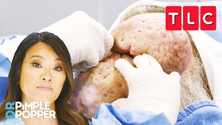 Dr Lee Treats The Largest Nasal Growths Shes Ever Seen  Dr Pimple Popper  TLC [upl. by Korenblat]