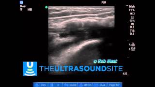 Ultrasound Guided Injection of Tibialis Posterior Tenosynovitis [upl. by Nenerb899]