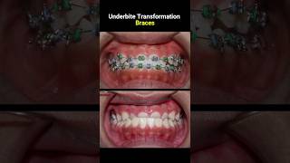 Underbite braces transformation braces orthodontist dentist bracket [upl. by Tessi377]