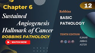 Sustained Angiogenesis Hallmark of Cancer Neoplasia Lecture 12 Robbins Pathology [upl. by Nysila]