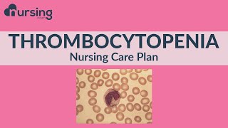 Nursing Care Plan for Thrombocytopenia Nursing Care Plan Tutorial [upl. by Phonsa497]