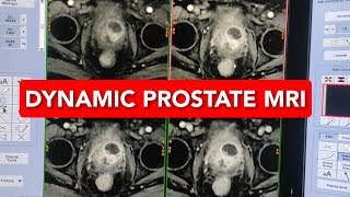 Dynamic Prostate Mri scan [upl. by Norvol]