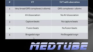 VT vs SVT with aberrancy Made Easy [upl. by Keraj]