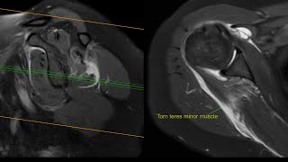 Teres Minor and Infraspinatus tear MRI [upl. by Dola]