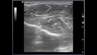 Medial Nerve  wrist to elbow Sonoanatomy  QMH AED Ultrasound Casebook 2013 Video 11 [upl. by Lati]