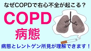 【国試によく出る】ＣＯＰＤの病態について解説 [upl. by Zelazny]