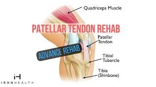 Patellar Tendon Rehab ADVANCE REHAB  Iron Health [upl. by Noirred290]