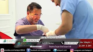 Otoplasty Surgery Live Surgery Full [upl. by Jerry557]