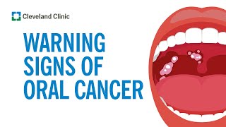 How to Screen Yourself for Oral Cancer [upl. by Enyamart]