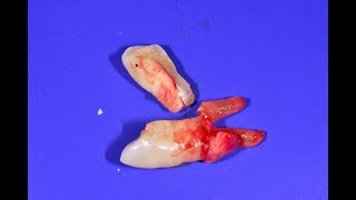 59 Extraction of a Fractured Premolar [upl. by Htiffirg325]