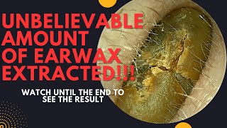 UNBELIEVABLE Amount Of Earwax Extracted From This Ear Watch Until The End [upl. by Eirelam119]