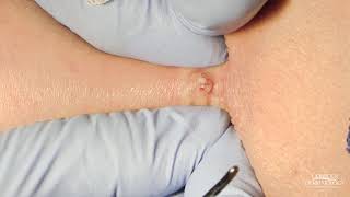 This quotTiny Pimplequot Gets Squeezed  Cyst Squeeze  CONTOUR DERMATOLOGY [upl. by Selby]