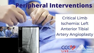 Critical Limb Ischemia Left Anterior Tibial Artery Angioplasty  March 28 2018 [upl. by Richia778]