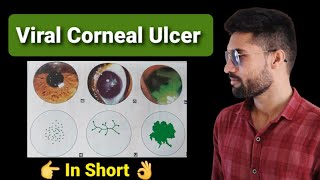 Viral corneal ulcer lecture opthalmology [upl. by Meingolda541]