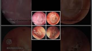 Acute Suppurative Otitis Media  Read more Link in description  Dr Rahul Bagla Teaching ENT [upl. by Nomra]