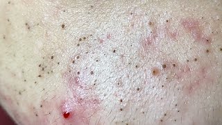 Acne Treatment Huong Da Nang The video has been lost for a long time Remove Blackheads [upl. by Eltotsira]