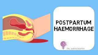 Postpartum Haemorrhage [upl. by Haleigh]