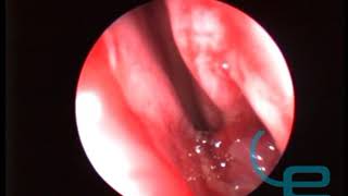 Biopsia de masa sobre mucosa olfatoria en perro mediante rinoscopia [upl. by Ecnarrot200]