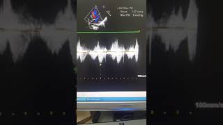 Case54 echocardiography  TOF with absent Pulmonary Valve [upl. by O'Connell887]