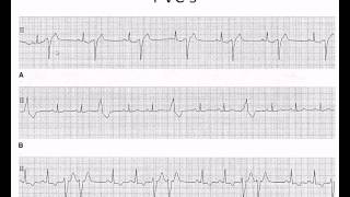 Easy EKG Premature Ventricular Contractions and Atrial Fibrillation [upl. by Alakam]