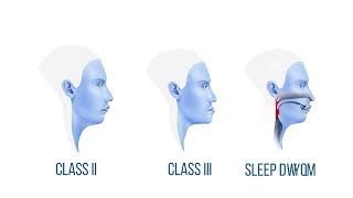 Orthognathic Surgery Explained [upl. by Aleakim]