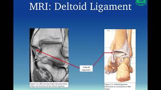 Deltoid Ligament [upl. by Shamma]