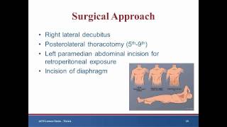 Keynote Lecture Thoracoabdominal aortic aneurysm [upl. by Skye]