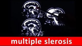 multiple sclerosis MS chronic autoimmune disease in MRI scan by RadiologyTV [upl. by Silsbye]