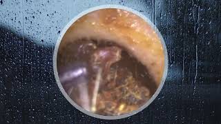 Huge Earwax Block Ear Drum Get Removed [upl. by Sicular]