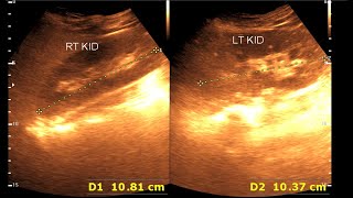 Fatty infiltration of the liver  Kidney Stone [upl. by Forkey]