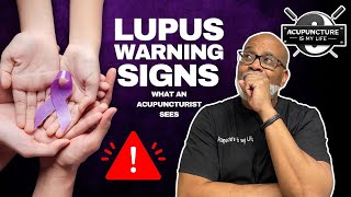 Can Acupuncturists Detect Signs of Lupus [upl. by Hailee582]