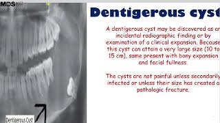 5 1 Dentigerous Cyst [upl. by Peder442]