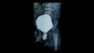 ProfDrPrathap Somnaths quotCashewnut and fruit signquot for posterior urethral valve [upl. by Oiuqise]